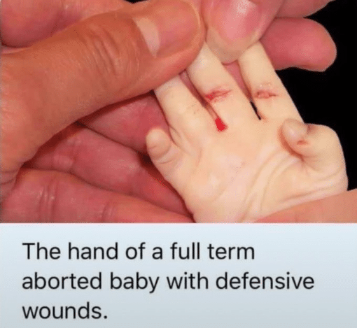 Abortion Memes, Funniest Memes  The hand of a full term aborted baby with defensive wounds 