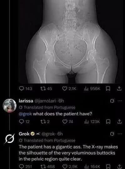 AI Memes, Ass Memes, Booty Memes, Butt Memes, Funniest Memes, Funny Comments Memes, Health Memes, Misunderstanding Memes, NSFW, Roast Memes, Social Media Memes, Translation Memes, Twitter Memes, The meme is a dark-mode social media screenshot centered on a pelvic X-ray. The X-ray shows the patient’s hips and lower spine, but the most visually obvious feature is the large rounded outline around the pelvis, which gives the scan a cartoonishly exaggerated silhouette. Below the image, a user asks Grok, “what does the patient have?” as if expecting a medical diagnosis. Grok replies in a blunt, clinical-sounding way that the patient has “a gigantic ass,” then doubles down by describing the “very voluminous buttocks” visible in the pelvic region.
